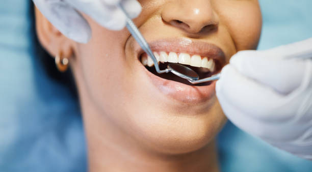 Best Emergency Dental Care for Broken or Chipped Teeth in Grizzly Flats, CA
