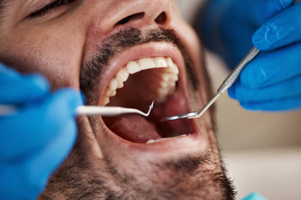 Best Emergency Treatment for Dental Infections or Abscesses in Grizzly Flats, CA