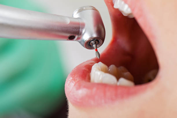 Best Emergency Tooth Extraction in Grizzly Flats, CA